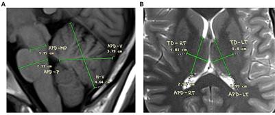 Morphological characteristics of cerebellum, pons and thalamus in Reccurent isolated sleep paralysis – A pilot study
